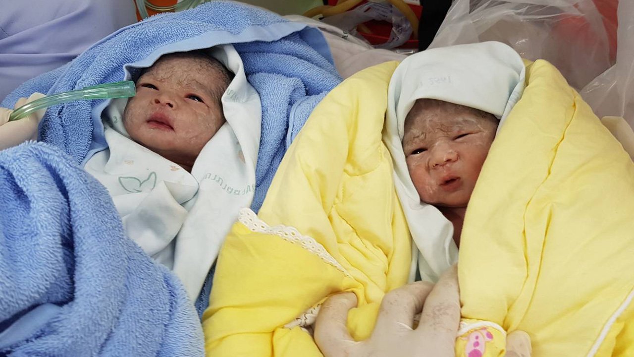 ฝันว่าคลอดลูกแฝด Haihuay