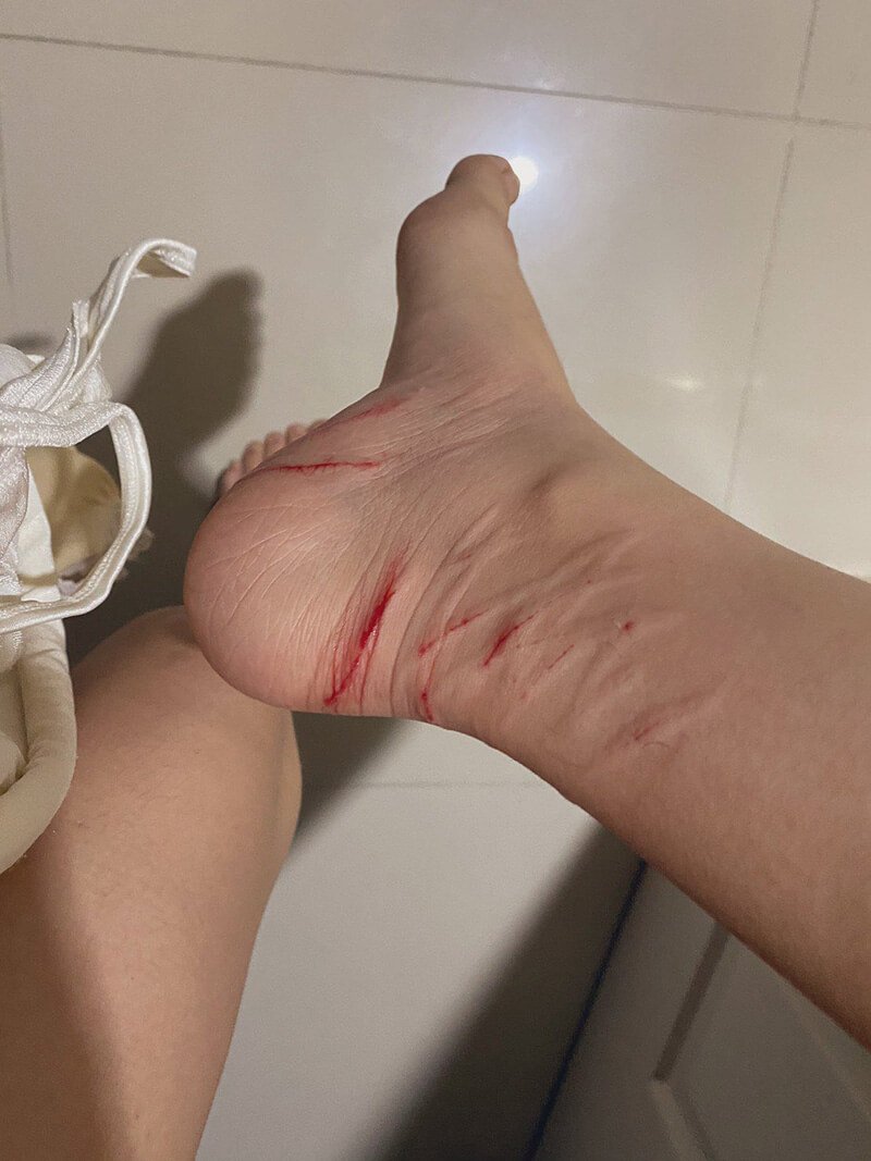 แมวกัดเท้า