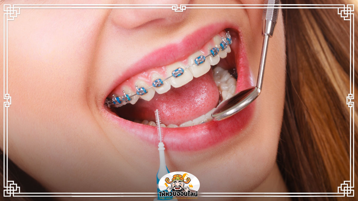 image-ฝันว่าจัดฟัน ฝันเห็นคนจัดฟัน ตีเลขเด็ด เปิดความหมาย คำทำนาย 256