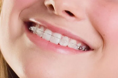 จัดฟัน