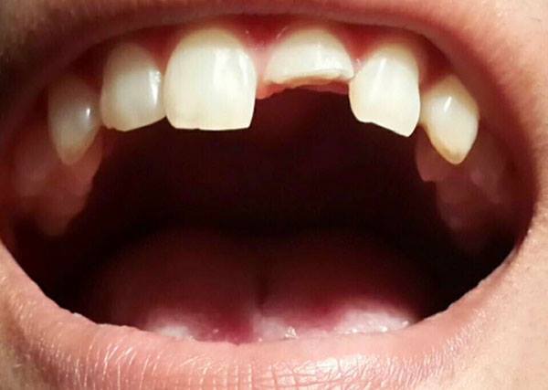 ฝันว่าฟันร่วง