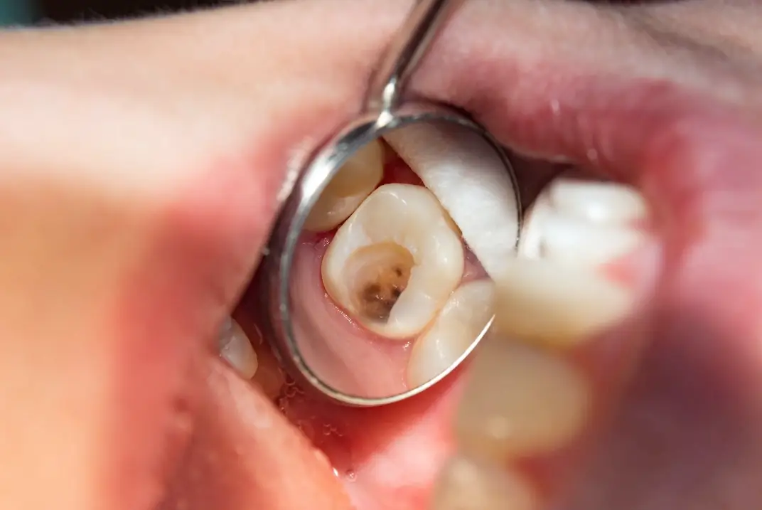 ฟันกรามหลุด