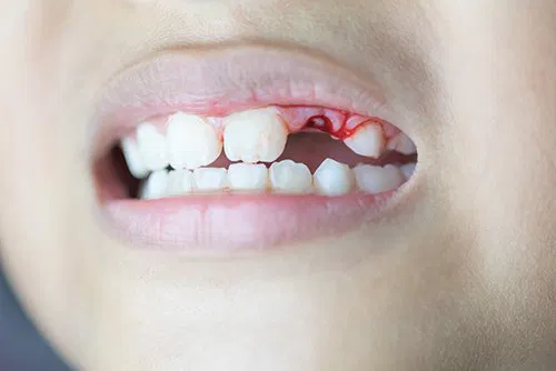 ฟันร่วง